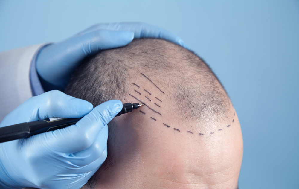 Know Your Hair Transplant 
